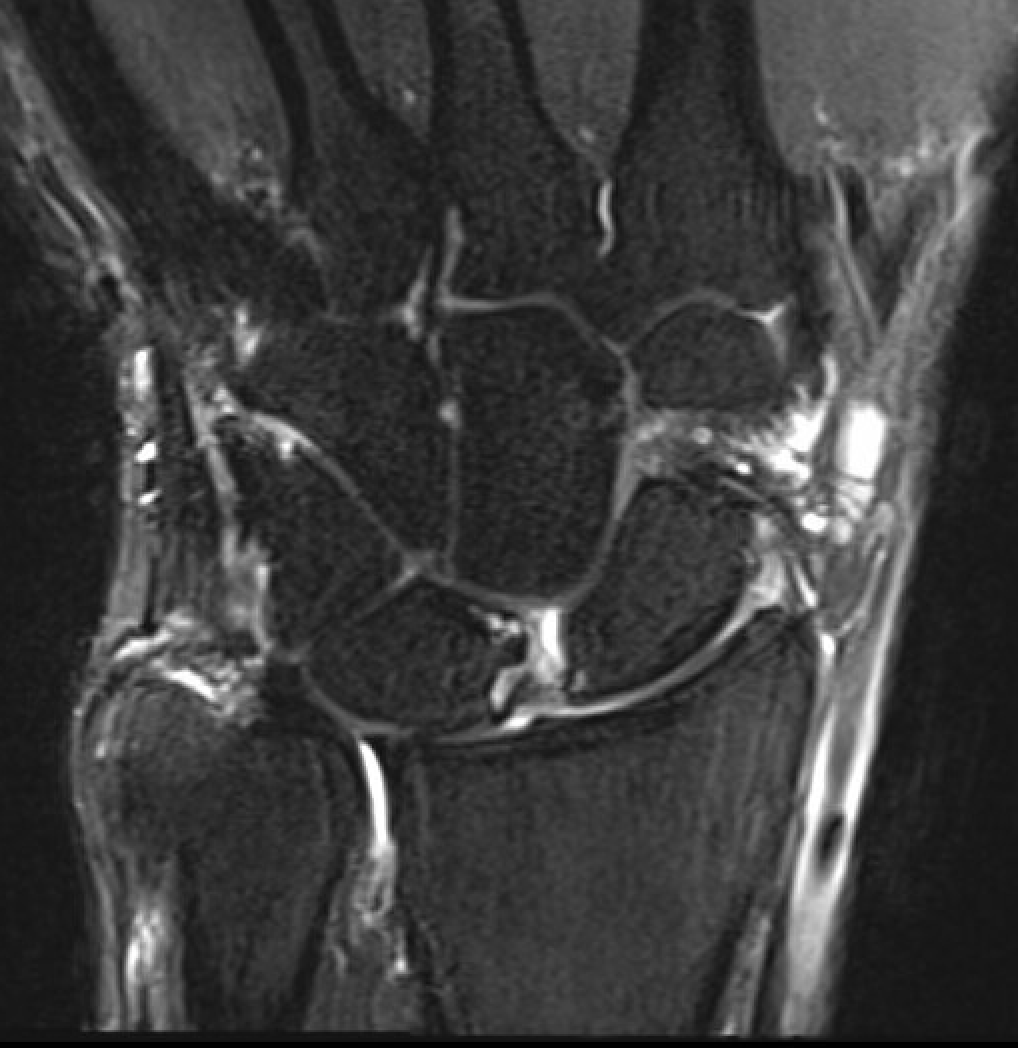 scapholunate-ligament-injury-the-bone-school